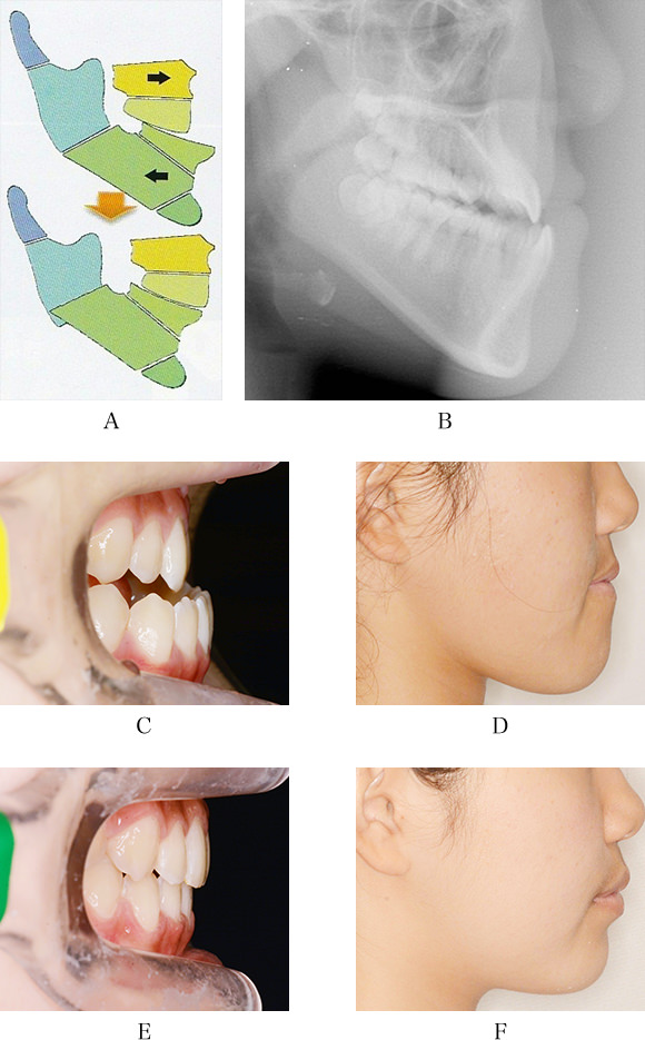 ♡裁断済 虫歯思いの歯科矯正治療 患者思いの歯科矯正治療 GPが実践したい部分矯正・咬合誘導・全